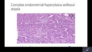 Endometrial hyperplasia Dr M Ramadan [upl. by Enelegna803]