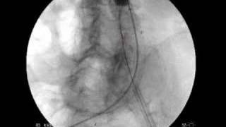 Endovascular Aneurysm Repair For AAA [upl. by Ojyllek]