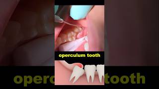 Operculum tooth treatment dentist dentistry wisdomtooth [upl. by Ardnas]