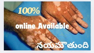 Acupressure for leucoderma and vitiligo by magnet therapy online treatment available [upl. by Pen]