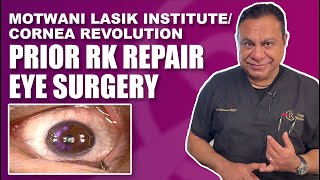 Corneal RK Radial Keratotomy Repair with Topographic Guided Ablation [upl. by Rori]