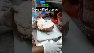 calcified uterus  histopathology [upl. by Waterer]