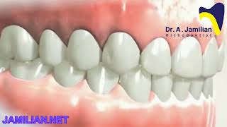 Utilization of TipBack Bend Technique for Deep Bite Correction in Orthodontic Treatment [upl. by Trinatte]