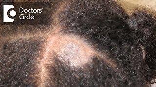 What causes Scalp Ringworm Effective Treatment   Tinea Capitis  Dr Tina Ramachander [upl. by Calvert]