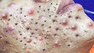 Big Cystic Acne Blackheads Extraction Blackheads amp Milia Whiteheads Removal Pimple Popping  6551 [upl. by Lauren266]