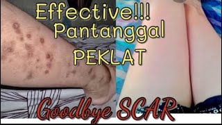 Paano Mawala Ang PEKLAT  Effective Pantanggal Ng PEKLAT  Scar Remover  💯√ [upl. by Aneetsirhc]