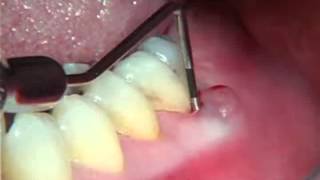 Endodontics Torabinejad 61 Perio of Pulpal Origin [upl. by Ester]