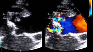 Infective Endocarditis  Aortic Root Abcess [upl. by Cohligan]