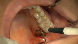 Palatal Fibrous Hyperplasia Excision [upl. by Yspyg]