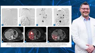 Treating Renal Cell Carcinoma with SIRT  Selective Internal Radiation Therapy [upl. by Eittocs]