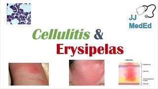 Cellulitis vs Erysipelas  Bacterial Causes Risk Factors Signs and Symptoms Treatment [upl. by Liuka345]