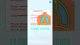 Everything About quotPleural Effusionquot Under One Minute [upl. by Karna]