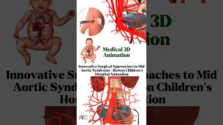 Innovative Surgical Approaches to Mid Aortic Syndrome  Boston Childrens Hospital Animation short [upl. by Lacram91]