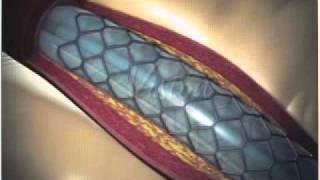 Angioplastia con Stent Parte 22  FOSCAL [upl. by Ydnerb]