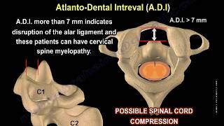 Rheumatoid Arthritis of the cervical spine  Everything You Need To Know  Dr Nabil Ebraheim [upl. by Riebling]