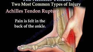 Achilles Tendon rupture tear tendonitis  Everything You Need To Know  Dr Nabil Ebraheim [upl. by Acenom449]