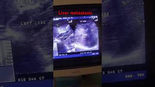 Liver Metastasis Ultrasound appearance ultrasound baby ultrasound humanhealthanddiseaseclass [upl. by Nosloc258]