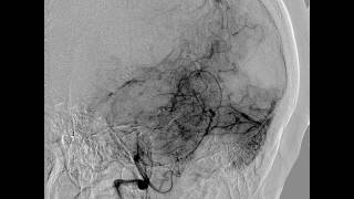 Diagnostic Cerebral Angiography and technique of vertebral artery catheterization [upl. by Foah]