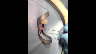 Dental Tooth Nerve removed live from Patient [upl. by Sternlight]