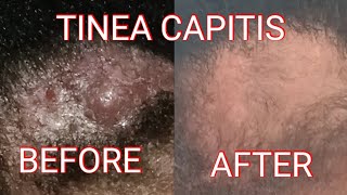 TINEA CAPITIS UPDATE [upl. by Sldney116]