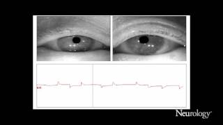 Alternating horizontal single saccadic pulses in progressive supranuclear palsy [upl. by Stalder]