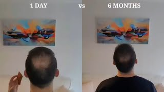 How to Derma Roll for Hair Regrow  My Half a Year Results [upl. by Uria847]