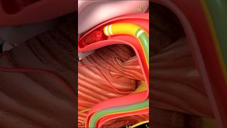 Thrombectomy machanical shorts medical science health nursingking [upl. by Greggory]