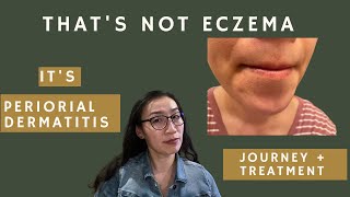 Thats not eczema its periorial dermatitis aka beard rash [upl. by Eehtomit]