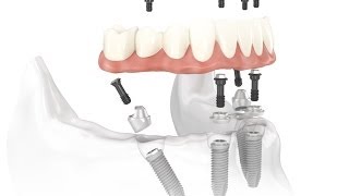 Dental Implant Osseointegration Process [upl. by Pell]