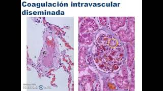 Coagulación Intravascular Diseminada  Dra Paola Gallego [upl. by Nosnevets]