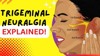 Trigeminal Neuralgia  Explained  Worlds most painful disease Causes and Treatment [upl. by Ellenid]