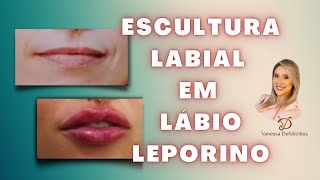 TÉCNICA DE CORREÇÃO DO LÁBIO LEPORINO  Método Escultura labial [upl. by Adrianna]