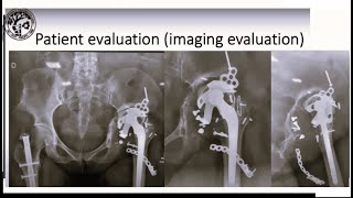 Acetabular Reconstruction in Revision THR [upl. by Yeo]