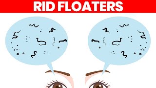 Eye Floaters What Are They amp How to Get Rid of Them [upl. by Inness]