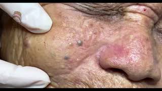 Relax Every Day acne pimplepopping blackheads [upl. by Akila]