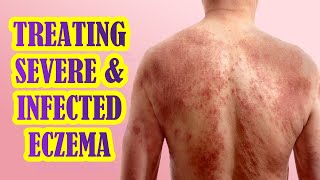 How To Manage Infected and Severe Eczema  Treatment Options [upl. by Jehias886]