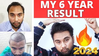 My Full Hair Transplant Result Journey Of 6 Years  How Hair Transplant Results Changed My Life 2024 [upl. by Ecire287]