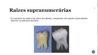 Alterações de desenvolvimento dos dentes anomalias dentárias Resumos de odonto [upl. by Fugate727]