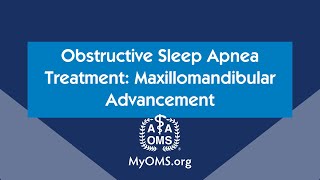 Obstructive Sleep Apnea Treatment Maxillomandibular Advancement [upl. by Ixel677]