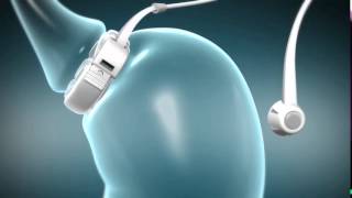 LapBand Video  New Hope Surgical Chicago [upl. by Maurizia]