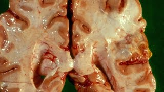 Cerebral Ischaemia and Infarction  Pathology mini tutorial [upl. by Ielirol]