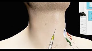 Spasmodic Dysphonia Treated with EMG Guided Botox Injection [upl. by Derdle829]