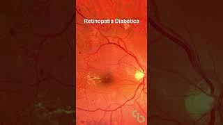 Retinopatia diabética proliferativa [upl. by Aicatan]