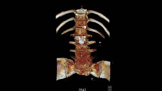 L45 spondylolytic spondylolisthesis [upl. by Venable431]