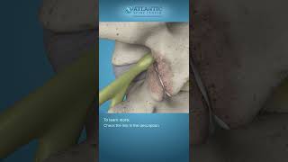 What is Endoscopic Lumbar Foraminotomy Shorts Atlantic Spine Center [upl. by Bonina]