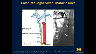 SIRRFS Webinar 06182018 Basic and Advanced Lymphatic Interventions State of Practice [upl. by Ettebab]