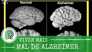 Conheça os primeiros sintomas do mal de Alzheimer [upl. by Tijnar972]