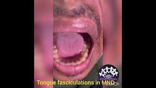 TONGUE FASCICULATIONS [upl. by Arbrab]