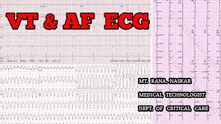 VENTRICULAR TACHYCARDIA amp ATRIAL FIBRILLATION ECG CRITERIAPATIENT FEATURESMT CCU [upl. by Dollar597]