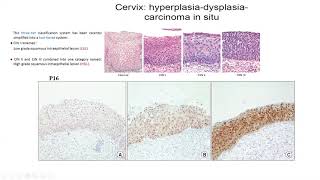 Pathology Made Easy 5 Neoplasia 1 General Features of Neoplasia [upl. by Aenitsirhc762]